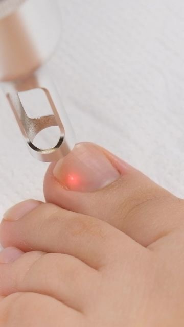 LÁSER PARA HONGOS EN LAS UÑAS. ONICOMICOSIS