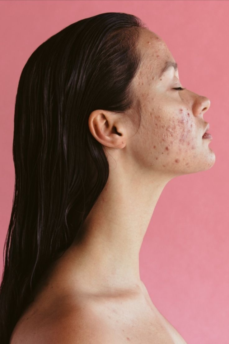 GLOW CLINICAL ACNÉ (PHOTOAGE + DIODO LÁSER