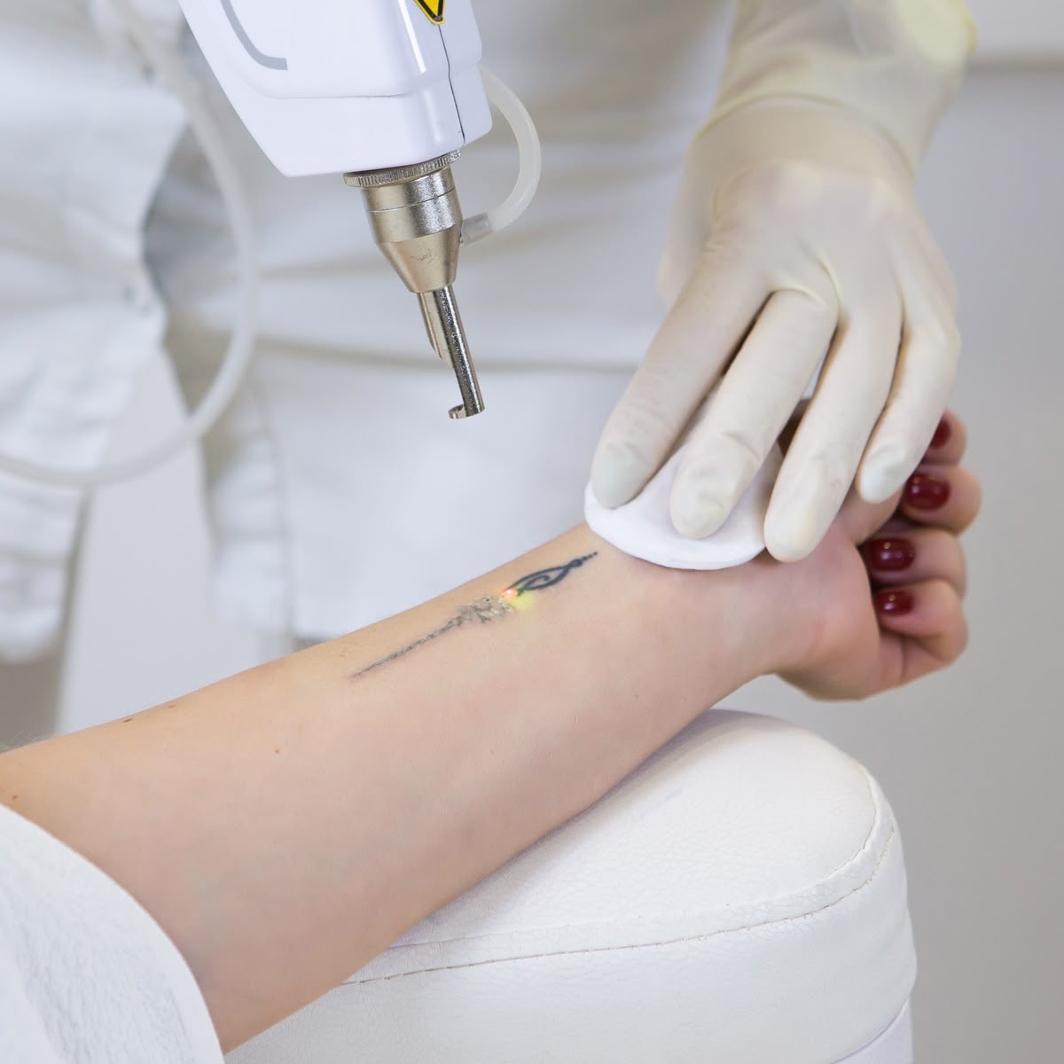 LÁSER REMOCIÓN DE TATUAJE